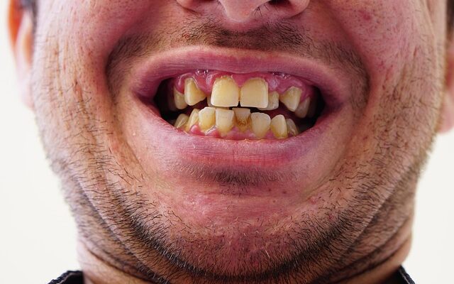 Myter og fakta om tandregulering – hvad skal du tro på?